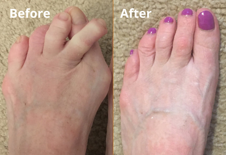 Silicone Toe Separator For Adults Bunion Corrector Splint Kit For Toe k60che-gk