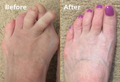 Silicone Toe Separator For Adults Bunion Corrector Splint Kit For Toe k60che-gk